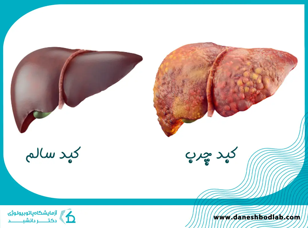 تفاوت گرید های کبد چرب